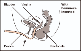 Femmeze on Twitter: "#rectocele #digitation #constipation Femmeze rectocele  device available on Amazon https://t.co/0DCmSKikXB https://t.co/nfS0QlJvwD"  / Twitter